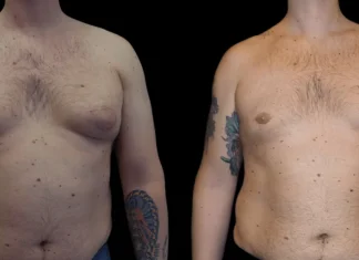 Understanding Male Breast Reduction Surgery: Causes and Treatments