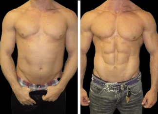 Are The Results Of An Abdominal Etching Permanent
